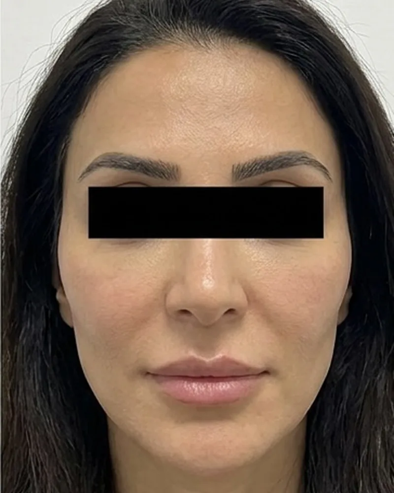 Sfera hybrid filler