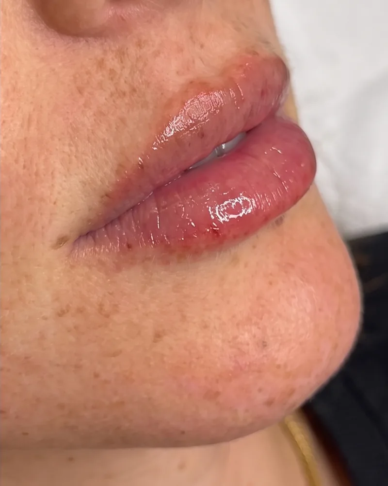 Lip filler