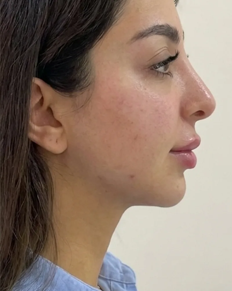 Chin and lip filler