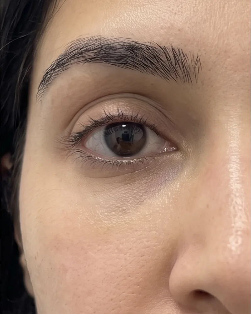 Under-eye hollow